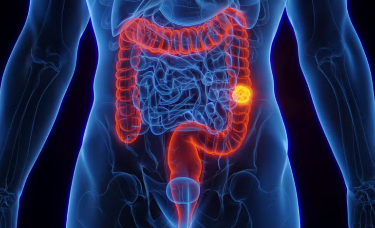 SUS adota novo exame para detectar câncer de intestino antes dos sintomas