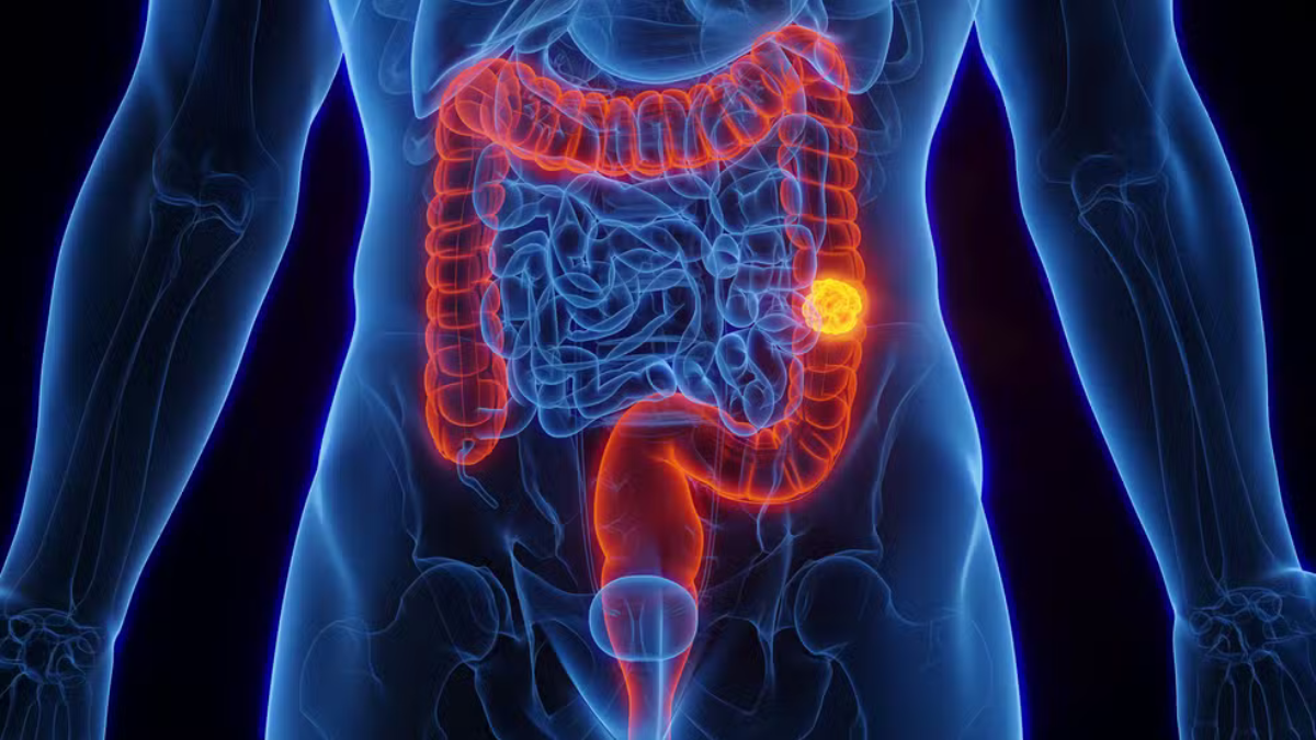 SUS adota novo exame para detectar câncer de intestino antes dos sintomas