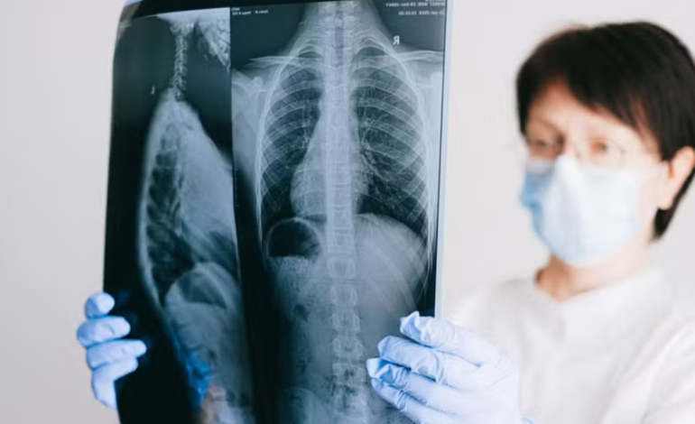 Medicamento Reduz em 94% o Risco de Metástase Cerebral em Pacientes com Câncer de Pulmão