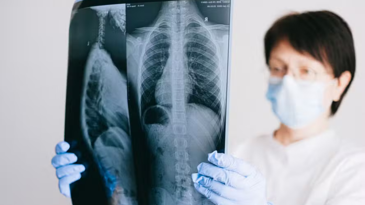 Medicamento Reduz em 94% o Risco de Metástase Cerebral em Pacientes com Câncer de Pulmão