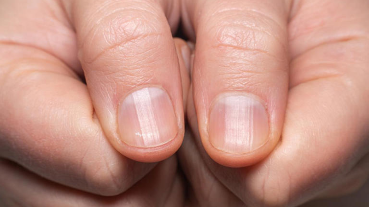 Sua pele e unhas podem revelar falta de vitaminas; veja 3 sinais de alerta