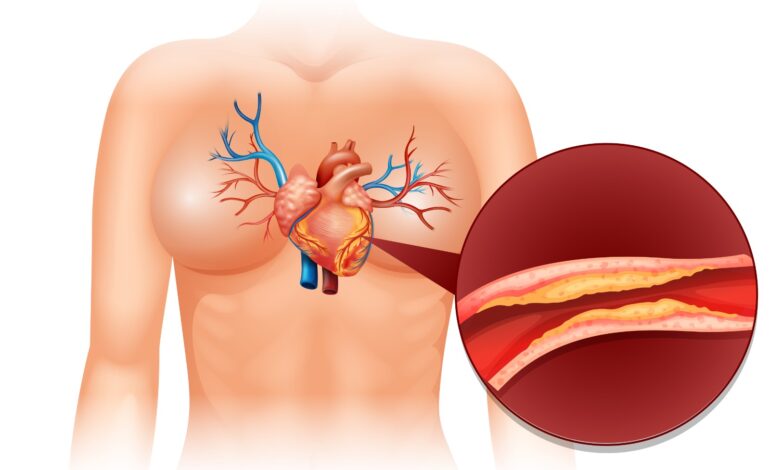 Colesterol alto: doença silenciosa afeta milhões de brasileiros e aumenta o risco de infarto e AVC