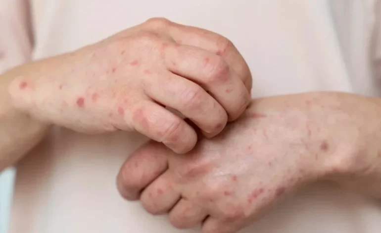 Coceira que piora à noite pode ser sarna: saiba o que fazer em caso de suspeita