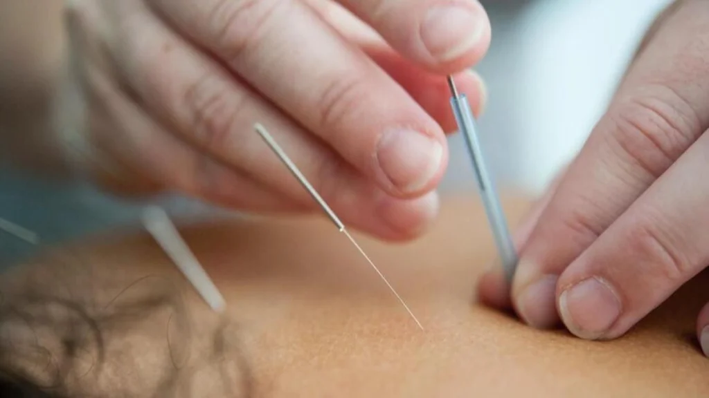 Acupuntura auxilia no tratamento da depressão, mas não substitui psiquiatria e terapia, alerta especialista | revistasaudeemforma.com.br SITES 5 3 1024x576
