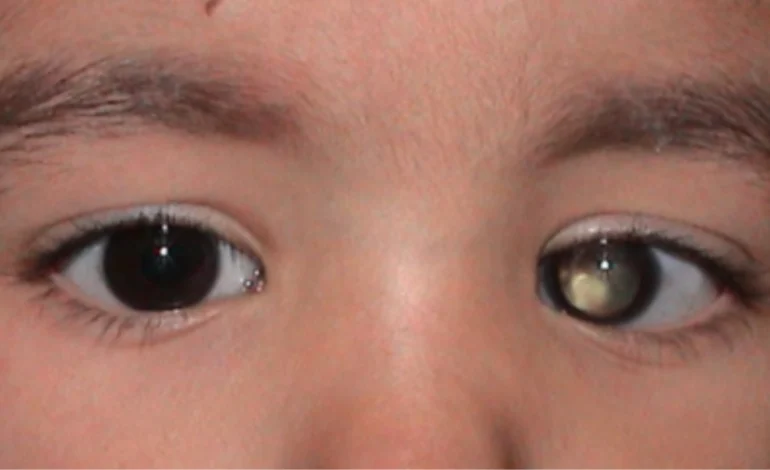 Retinoblastoma acomete 95% das crianças até 5 anos; saiba como identificar os primeiros sinais