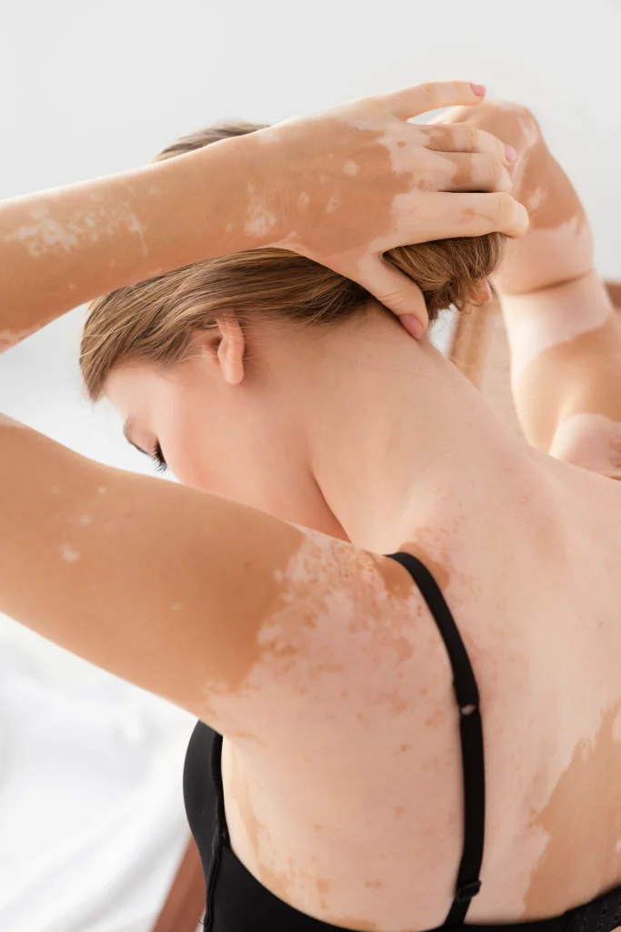 Doenças de pele afetam milhões de brasileiros: entenda os principais sintomas e como a acupuntura pode auxiliar | revistasaudeemforma.com.br beautiful young woman with vitiligo.jpg 683x1024