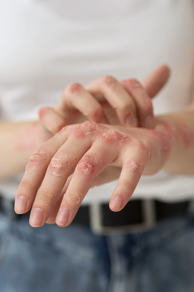 Doenças de pele afetam milhões de brasileiros: entenda os principais sintomas e como a acupuntura pode auxiliar | revistasaudeemforma.com.br hands patient suffering from psoriasis 683x1024