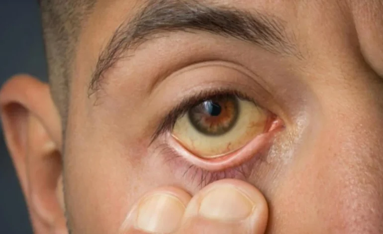 Pele e olhos amarelos? Entenda por que a icterícia é sinal de alerta para o fígado