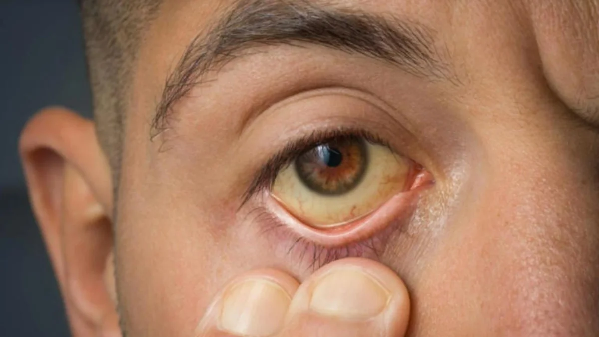 Pele e olhos amarelos? Entenda por que a icterícia é sinal de alerta para o fígado