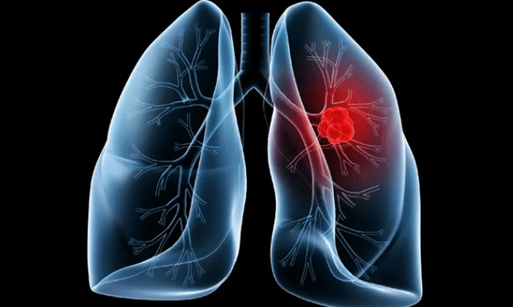 Saiba o que é adenocarcinoma pulmonar, câncer que atinge o papa Leão XIV | Revista Saúde em Forma image 9 1024x613